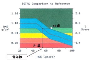 ≪図1≫ 加齢に伴う骨密度の変化と骨年齢の評価（68歳女性の例）